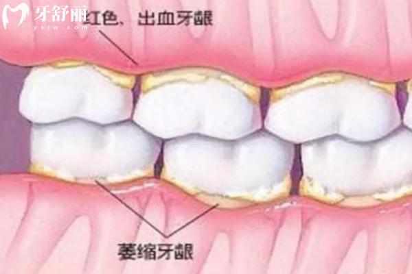 牙龈萎缩