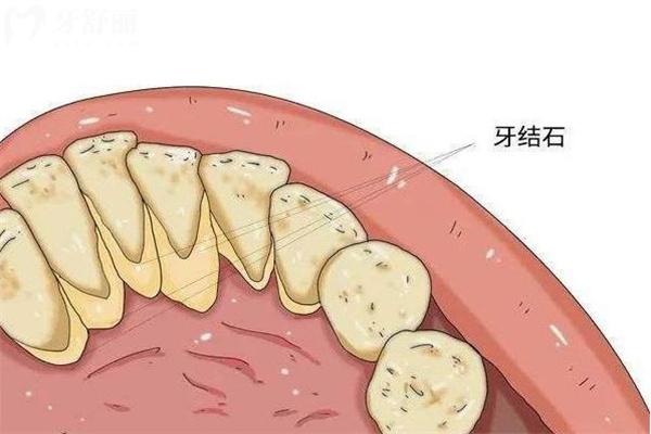 一般洗牙需要多长时间?多少钱?