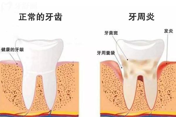 糖尿病牙周炎怎么治疗有效