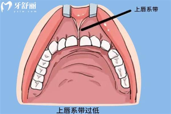 笑露牙龈与唇系带有关系吗？