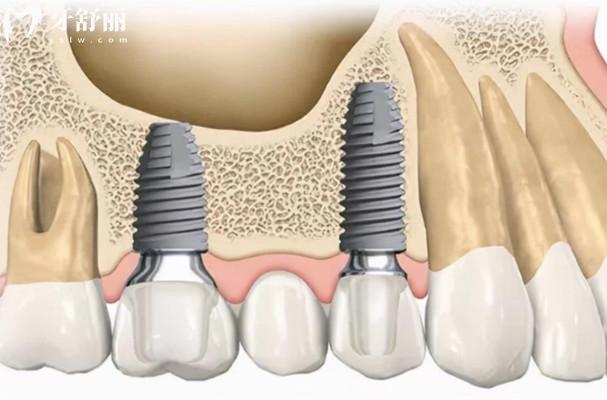 牙槽骨骨量不足的原因的是什么
