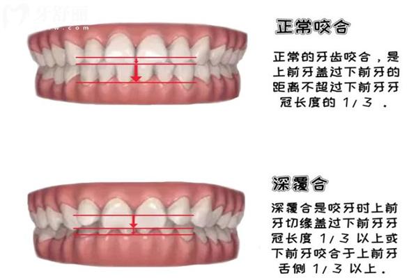 儿童深覆合矫正的必要性