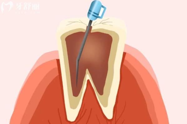 戴牙冠前为什么要磨牙呢?磨牙是保护牙齿还是伤害牙齿?