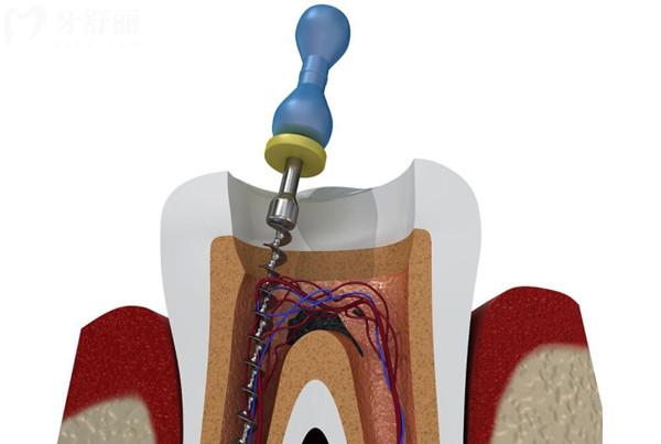 孩子补牙需要做根管治疗吗?杀神经对恒牙的生长造成影响吗?