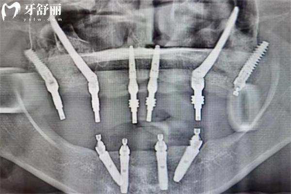上海鼎植口腔做全口种植牙33600元起!技术可靠价格实惠顾客评价高