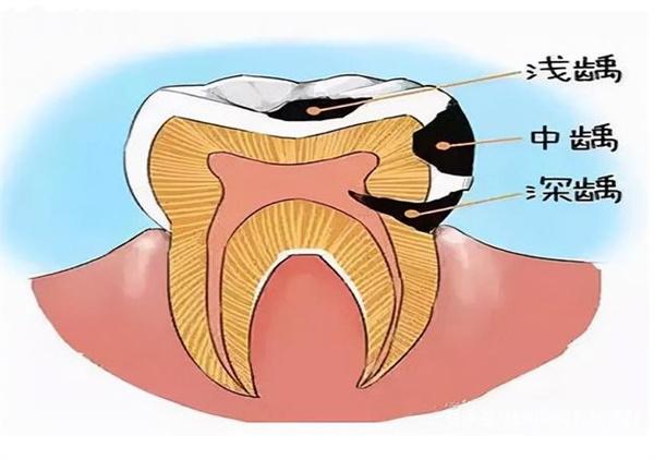 根管治疗解决什么牙齿问题