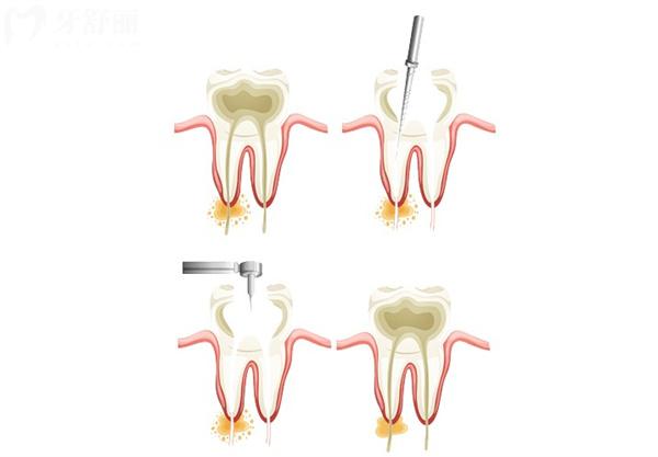 根管治疗的作用及目的有哪些