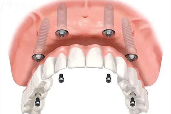 种植牙全口半口啥意思