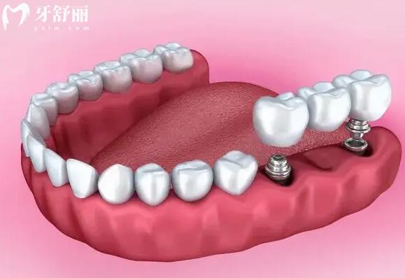 宁波拜博口腔医院种植牙多少钱?2024价格表:一颗1999全口4W便宜又好