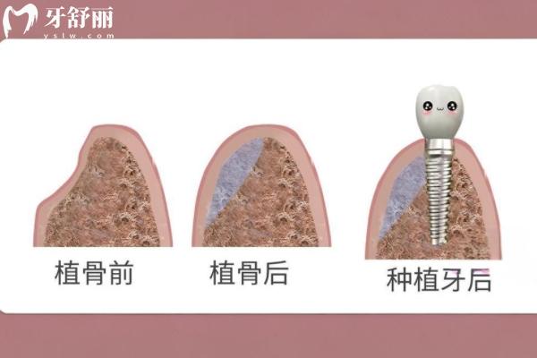 镶牙和种植牙有什么区别哪个好