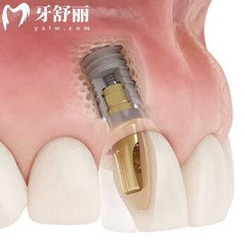 宁波牙博士口腔医院种植牙多少钱?2024价格表:一颗1980+半口1.8W+