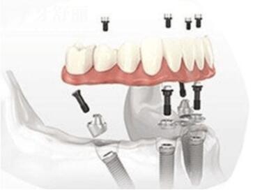 宁波牙博士口腔医院种植牙多少钱?2024价格表:一颗1980+半口1.8W+