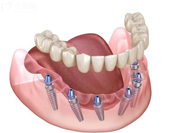 平谷区牙科医院全口种植牙多少钱