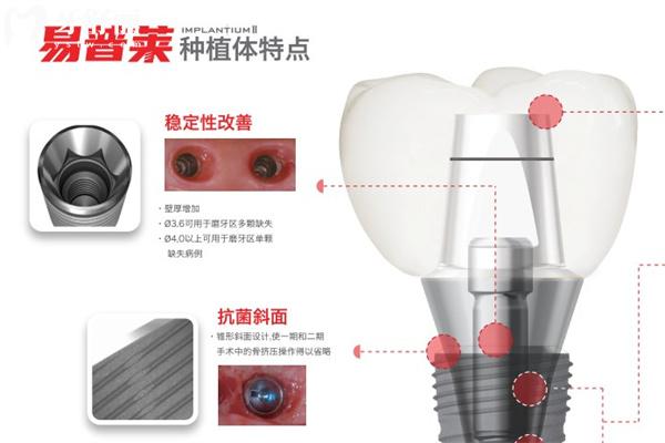 韩国易普莱种植牙特点