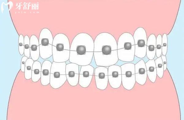 西宁牙齿矫正多少钱