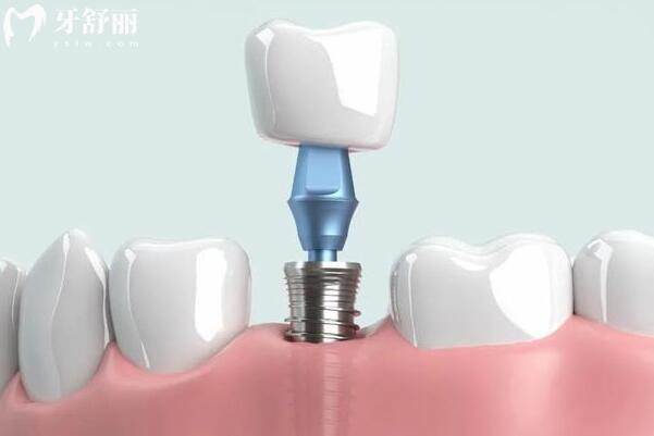 义乌牙科医院种植牙多少钱?2024价格表显示:一颗1980+