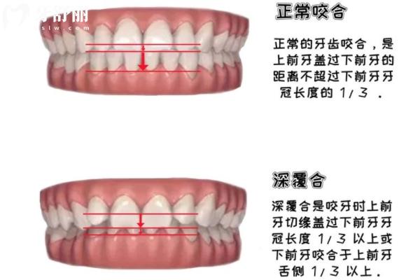 不影响美观的深覆合还需要矫正吗