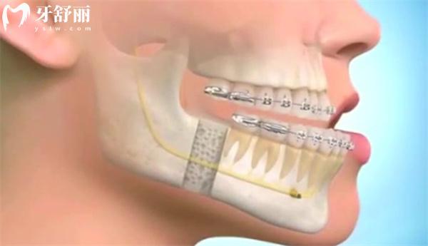 骨性地包天的治疗方法有哪些