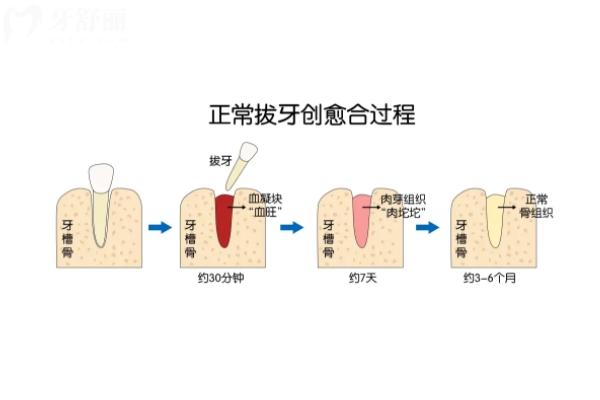 拔完牙后牙窟窿多久能长好