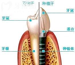 种植牙的材料有哪几种?种植牙材料会对身体有影响吗?