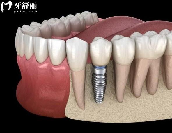 保定牙科医院种植牙价格表