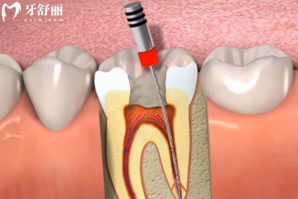 根管治疗完牙裂了怎么办