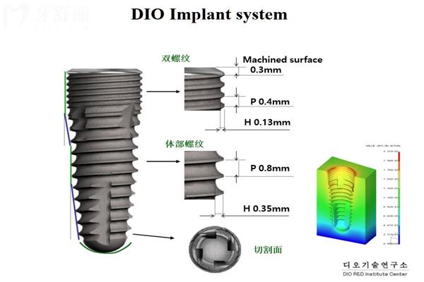 韩国dio种植体性能