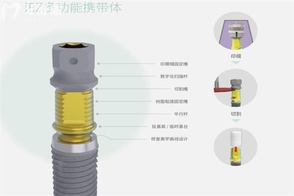 iEZ种植体