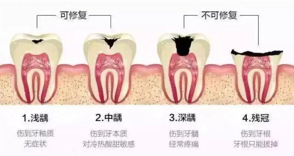 乳牙需要做根管治疗吗？