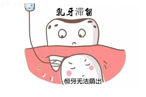 乳牙需要做根管治疗吗？