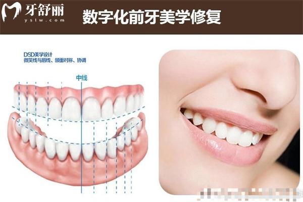 美学牙齿贴面十大品牌排名已出 国产/进口美学贴面材质价格信息分享