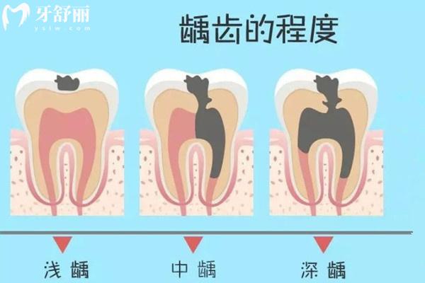 龋齿的发展过程