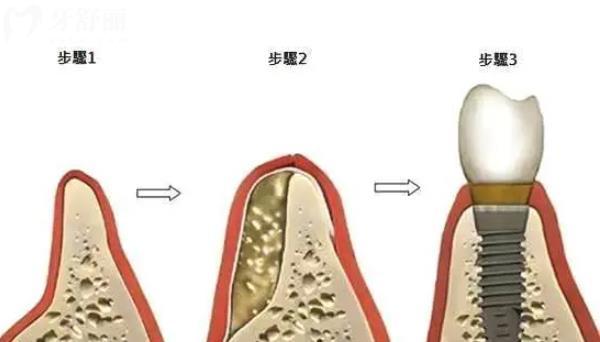 牙槽骨再生手术