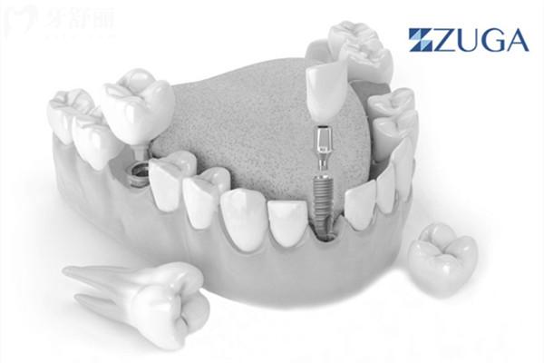 正规医院进口种植牙多少钱一颗