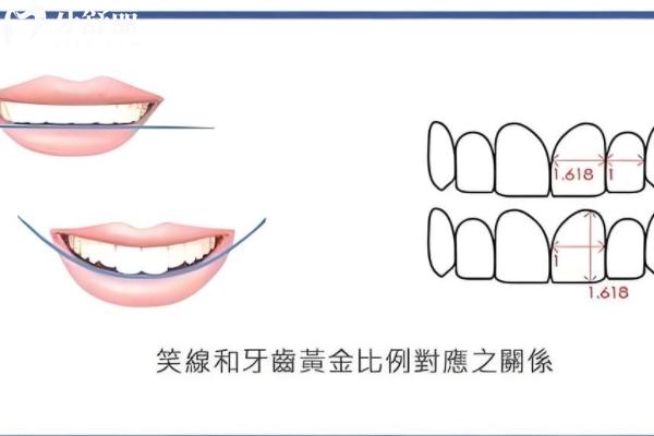 ‌‌VITA琥珀瓷贴面