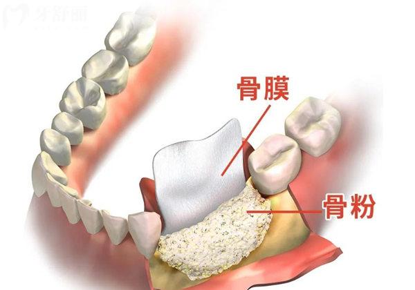 种植牙用的骨粉和骨膜有什么作用？