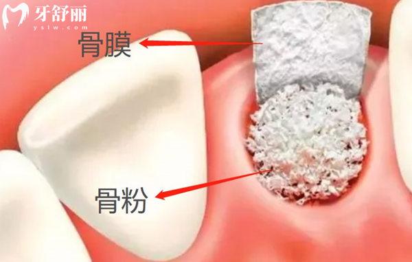 种牙用骨粉骨膜多长时间能消肿