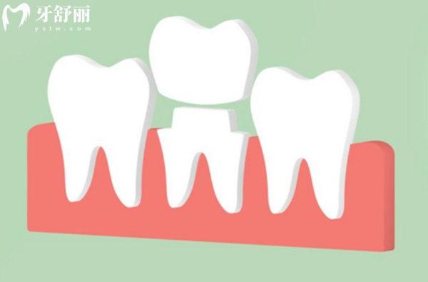 秦皇岛牙科医院镶牙多少钱一颗