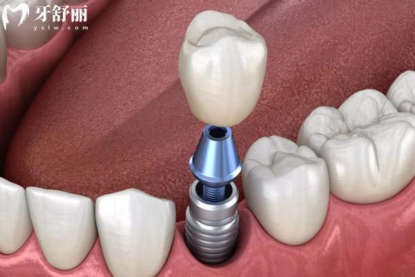 泸州牙科医院种植牙价格表