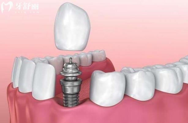 拔完牙多久可以镶牙?哪种镶牙方式比较好