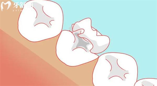 龋坏后补了牙的牙齿还会烂到牙髓么