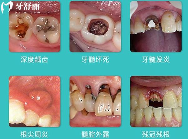 牙神经杀死后有什么影响