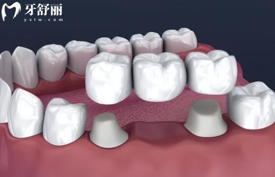 纯钛活动假牙能用几年?10-15年以上,使用寿命长短主要由这5个因素决定