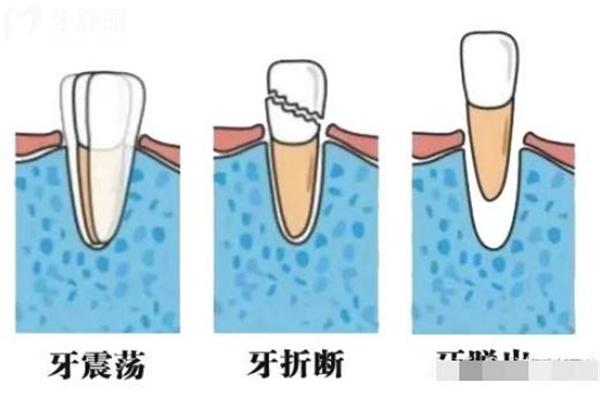 牙外伤常见的类型有哪些