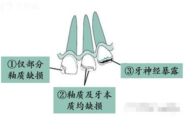 牙外伤常见的类型有哪些