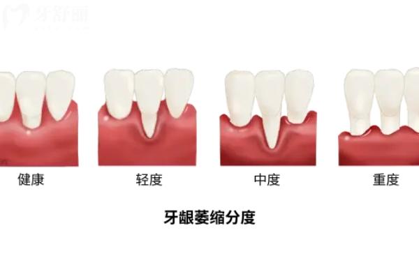 如何预防牙龈萎缩？