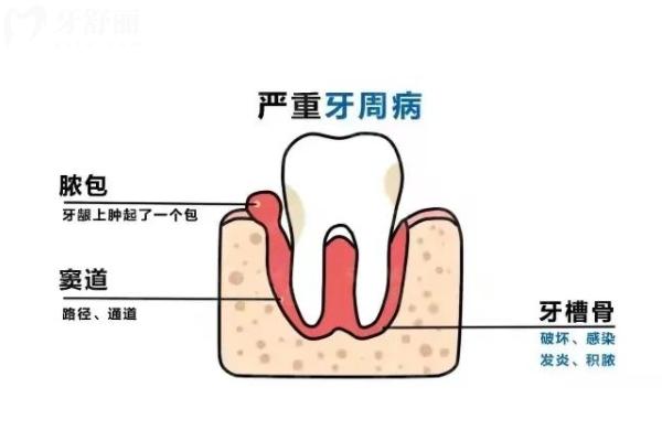 如何预防牙龈萎缩？