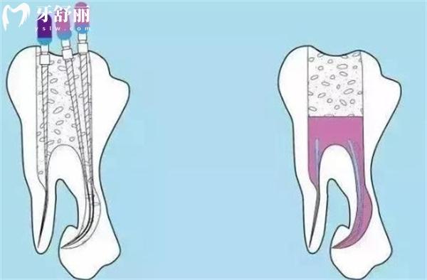 儿童乳牙做根管治疗的具体步骤