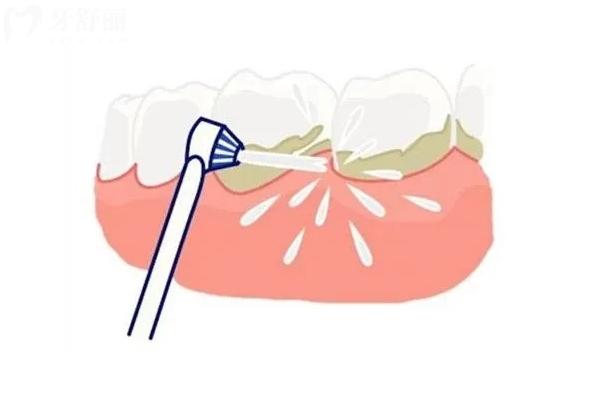 洗牙喷砂和不喷砂有什么区别？一文了解喷砂与不喷砂的优缺点