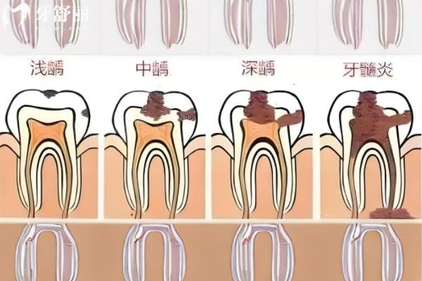 补牙后还是冷热刺激疼